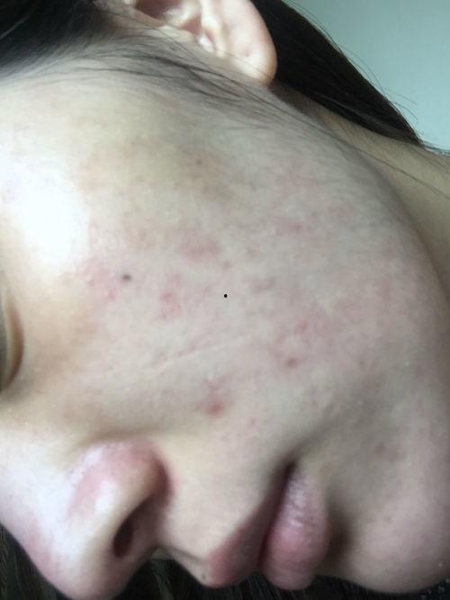 明星网红为什么没有痤疮,揭秘痤疮绝缘之谜