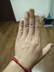 摘除胆囊的明星网红有谁,揭秘那些勇敢面对健康挑战的明星网红